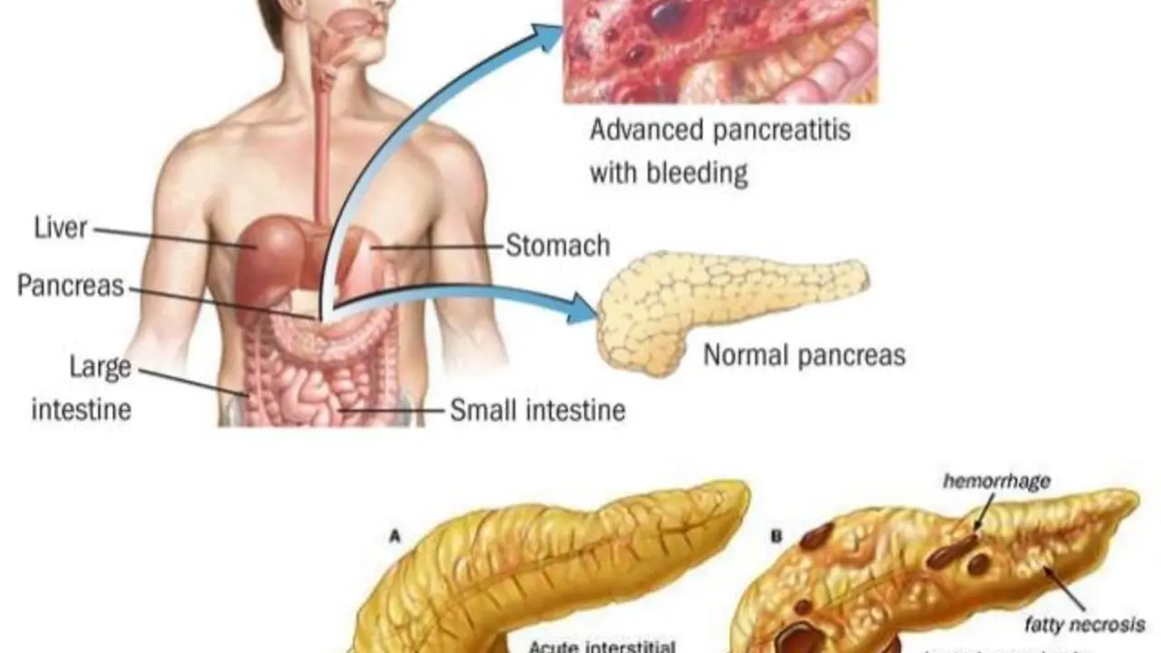 Simethicone and Pancreatitis: Can It Provide Relief?